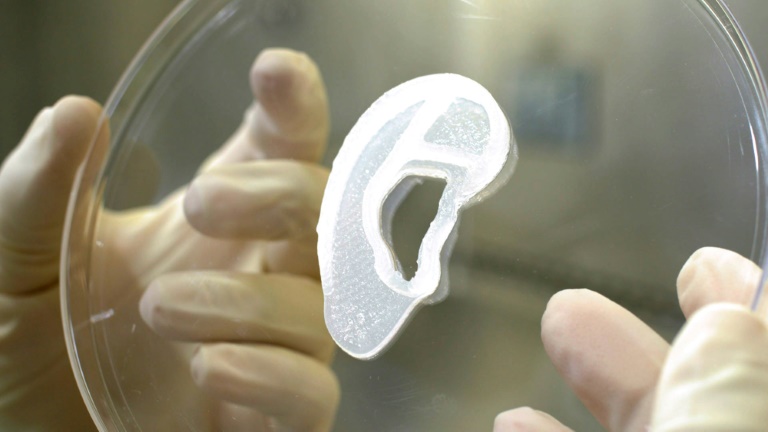  Surgeons transplant 3D ear made of living cells