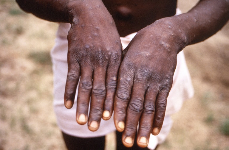  WHO to assess if monkeypox an international health emergency